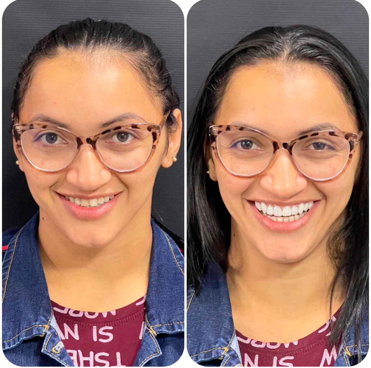 dra gabriela miranda soares dentista lentes de resina